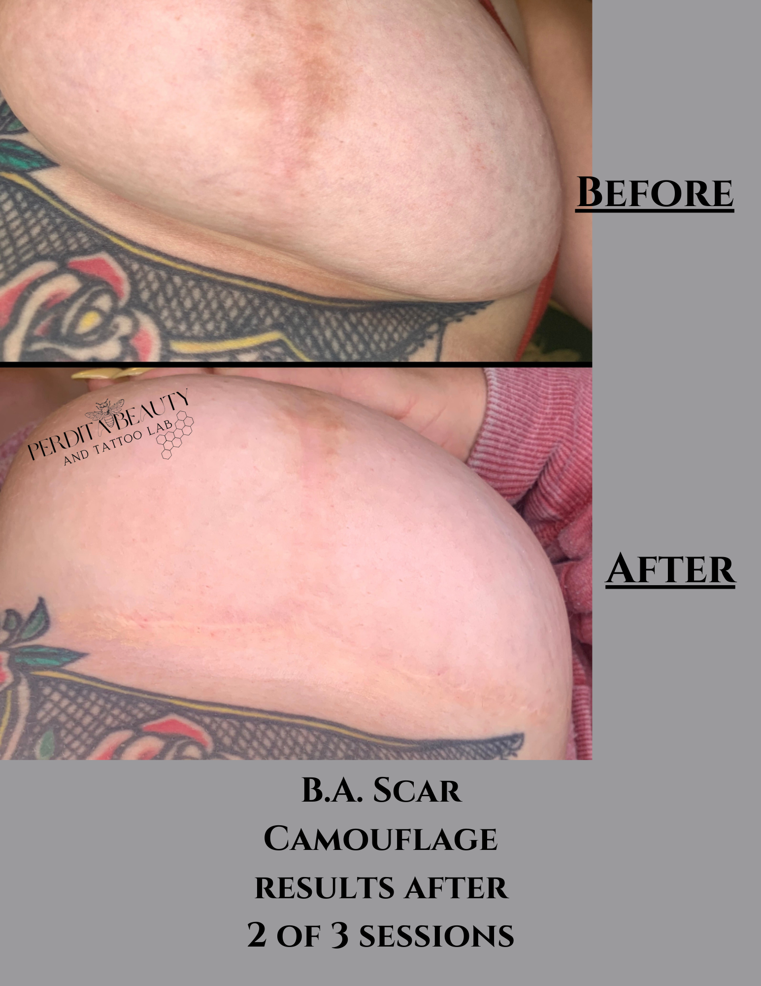 A picture of a woman 's breast before and after ba scar camouflage treatment