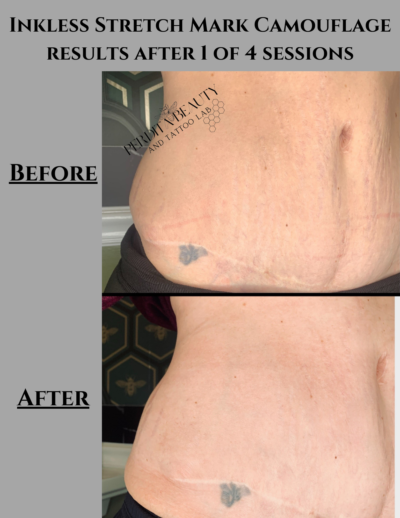 A picture of a woman 's stomach before and after inkless stretch mark camouflage