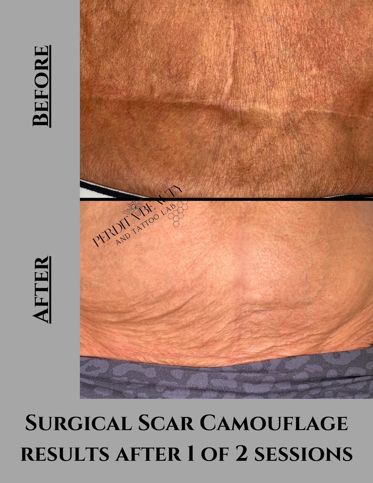Surgical scar camouflage results after 1 of 2 sessions
