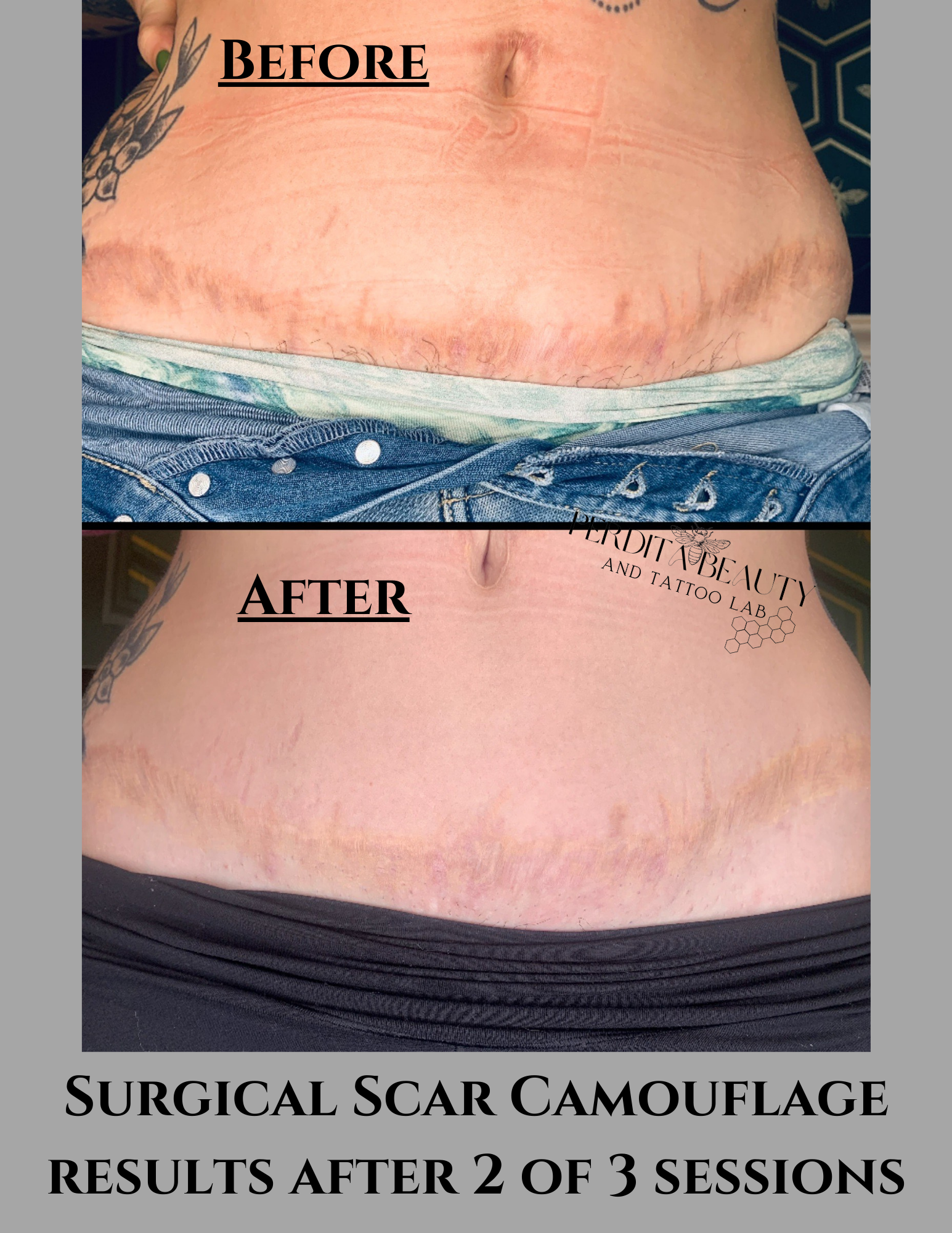 Surgical scar camouflage results after 2 of 3 sessions