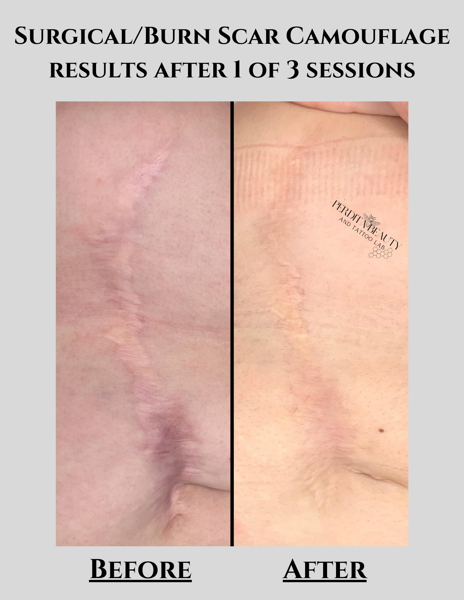 Surgical burn scar camouflage results after 1 of 3 sessions