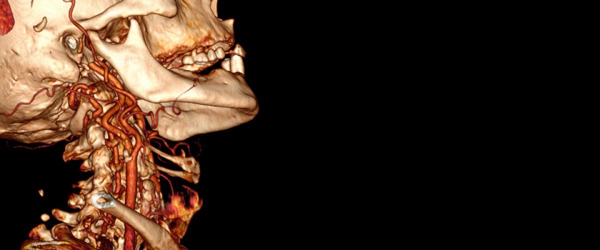 Carotid Disease Treatment