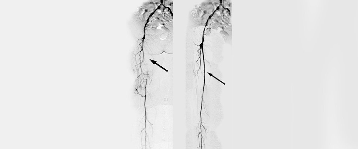 Peripheral Artery Disease Treatment