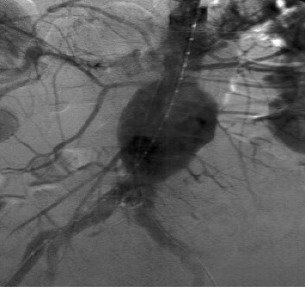Before Endovascular Stenting