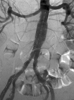 After Endovascular Stenting