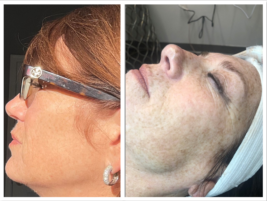 lady showing the side of her face