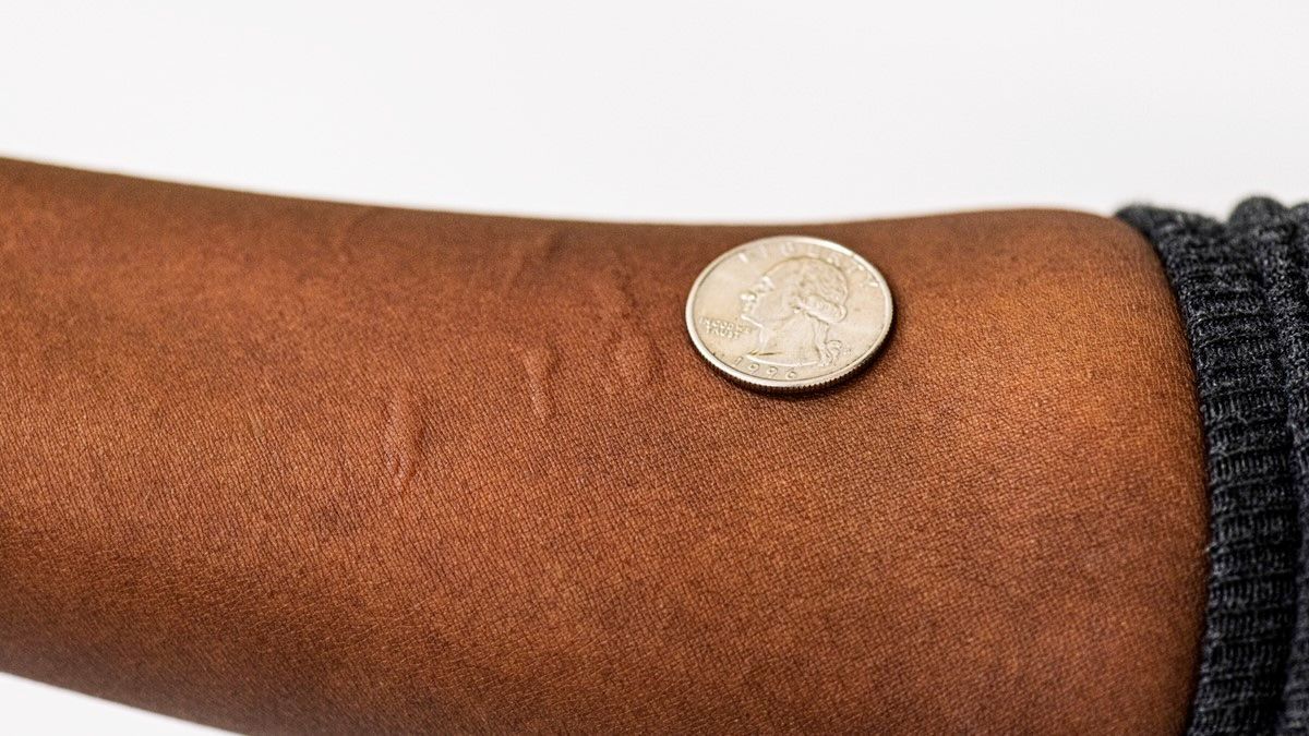 photo of mosquito bites