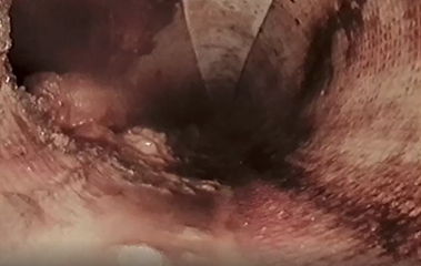 Solids Trapped at Joint