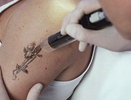 Tattoo laser removal
