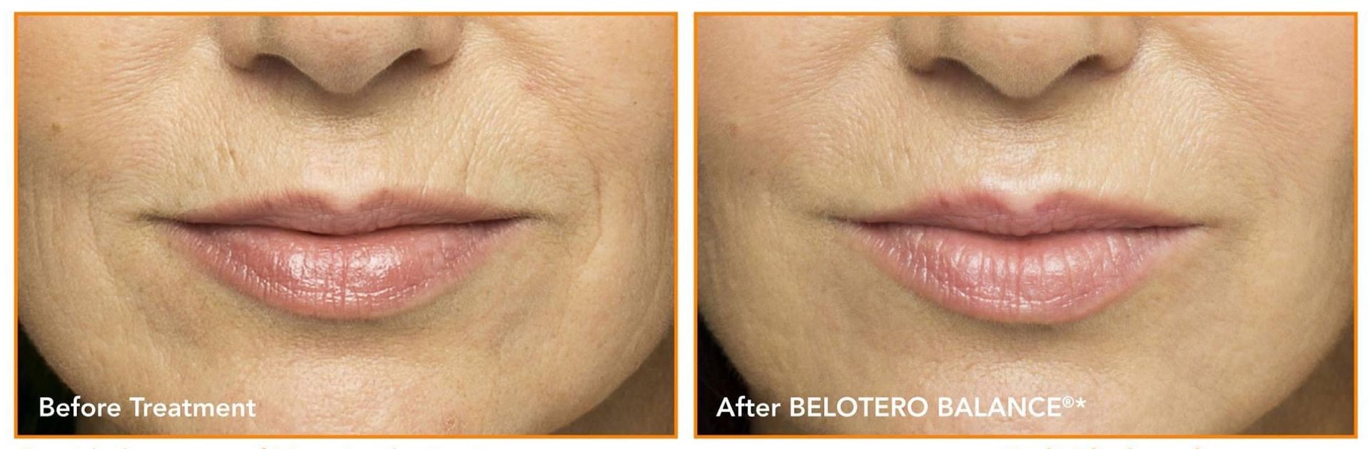 Before and After Belotero Treatment