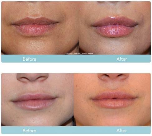Before and After Lips Filler