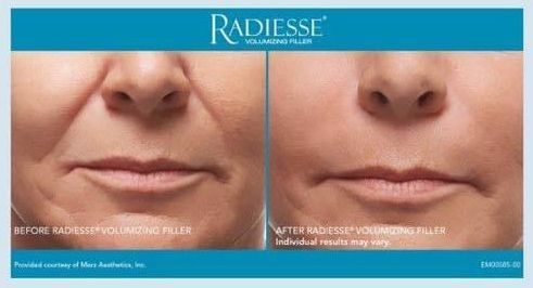 Before and After Radiesse Filler