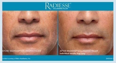 Before and After Radiesse Volumizing Filler