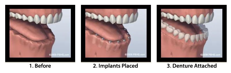 Screw Retained Denture