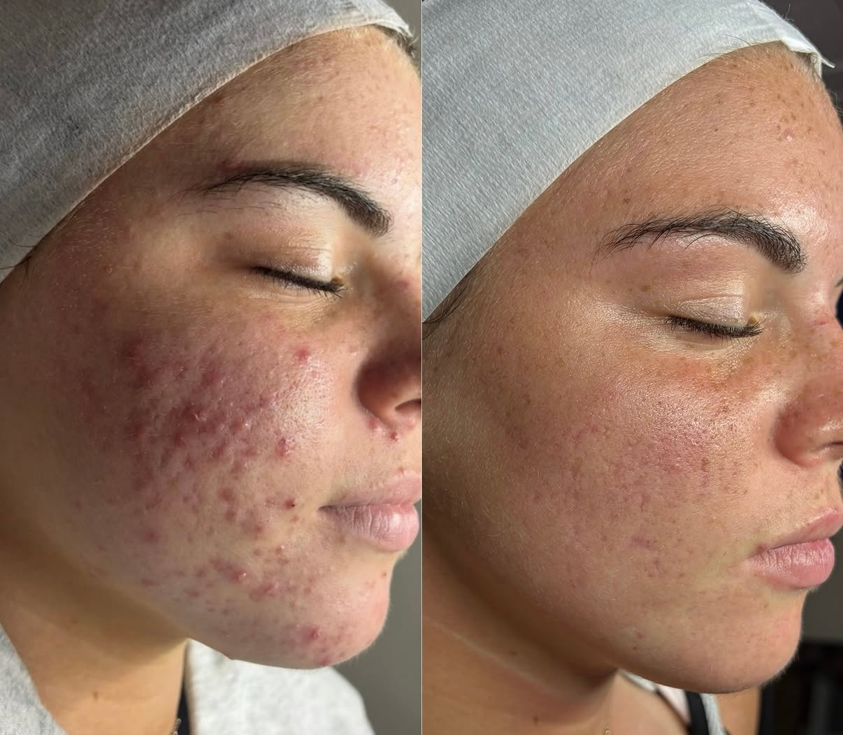 Omni Bridal Treatments