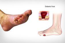 Diabetic feet