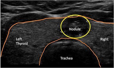 An ultrasound image of the left thyroid and right trachea.