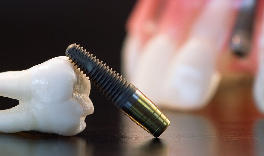 Dental implant next to a model tooth, with a tooth model in the blurred background.