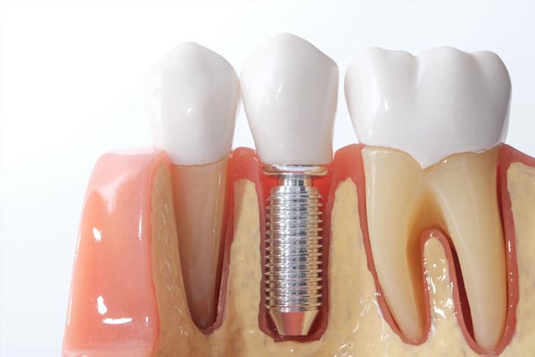 Dental Implants