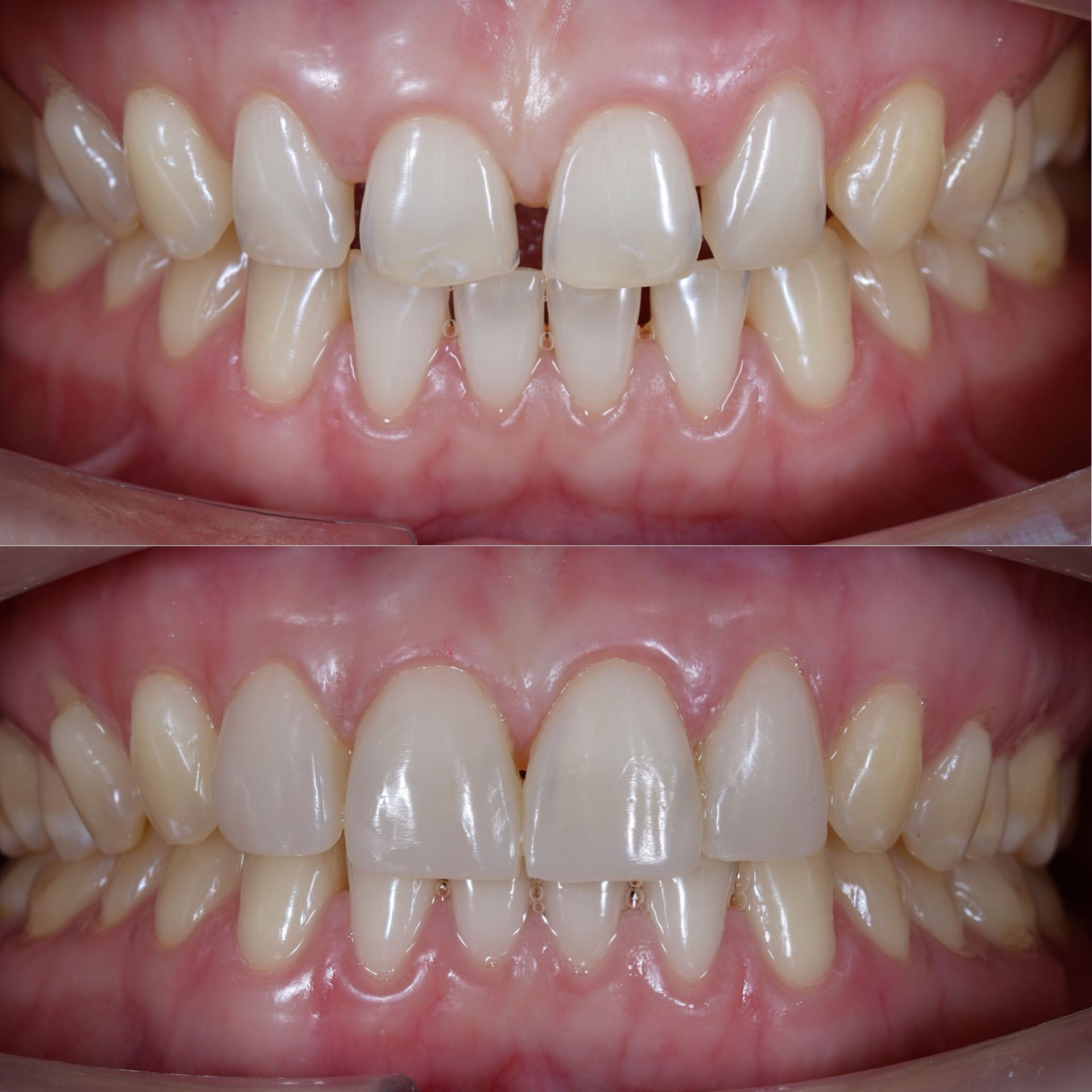 Top and bottom views of teeth before and after cosmetic dentistry to close gap.