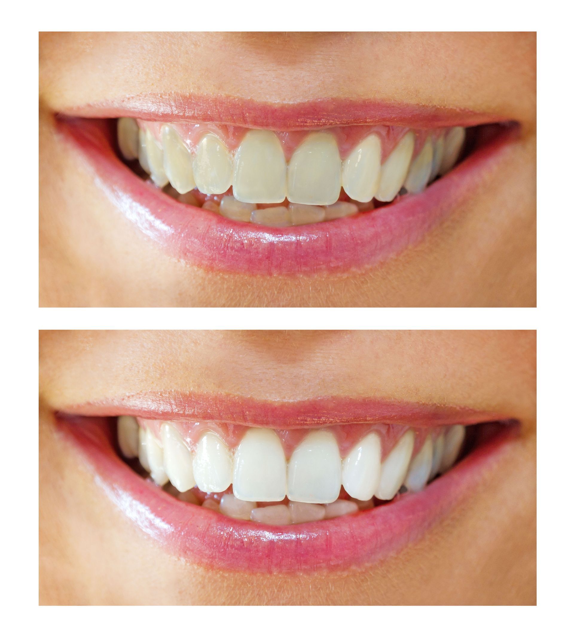 Smiling mouth with slightly yellow teeth (top) and white teeth (bottom), showing teeth whitening effect.