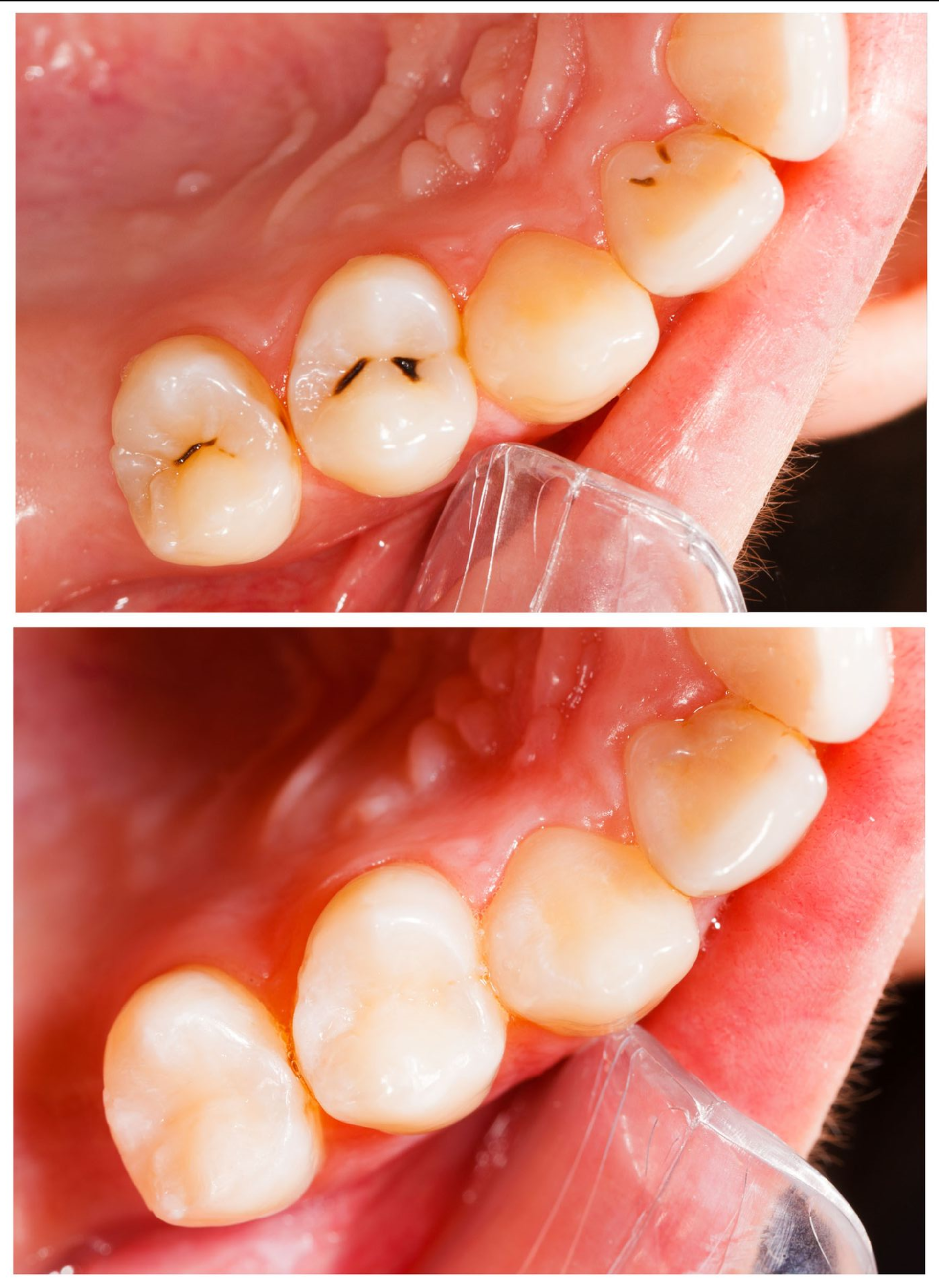 Top: tooth with black cavity. Bottom: tooth after filling.