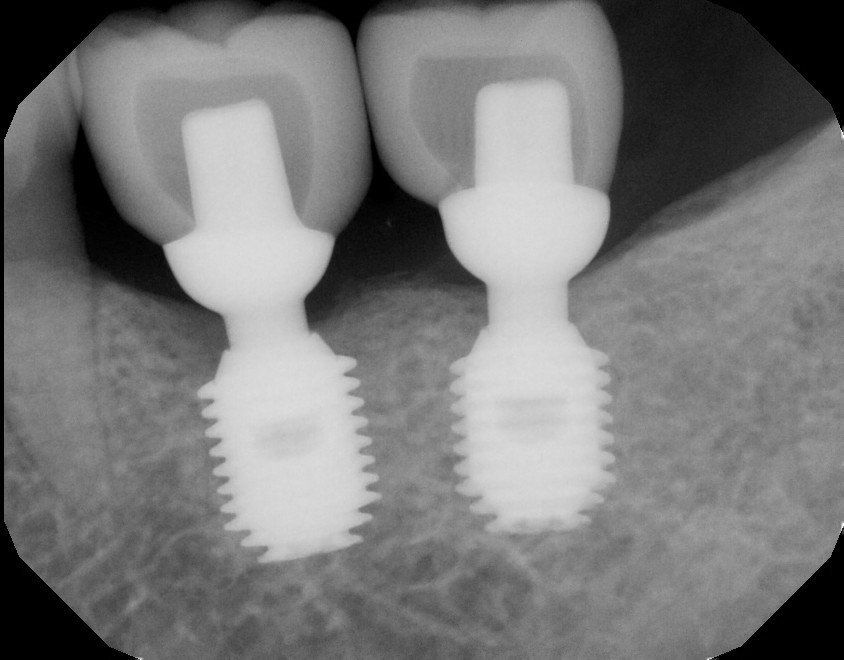 Dental x-ray showing two white dental implants screwed into the jawbone, supporting crowns.