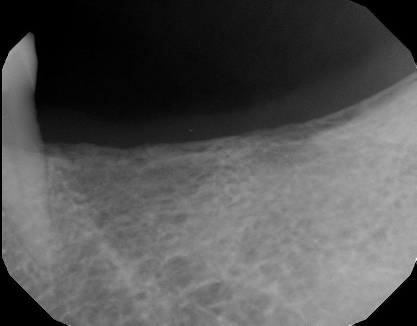 Mammogram showing breast tissue with dense, fibrous patterns.