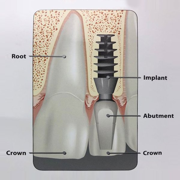 Diagram of a dental implant, showing the root, crown, abutment, and implant screw within the jaw.