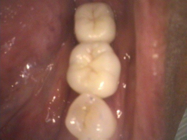Close-up of dental crowns in a mouth; three teeth in a row, light beige color.