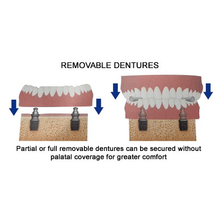 Diagram showing removable dentures secured to implants. Blue arrows indicate placement. Text states