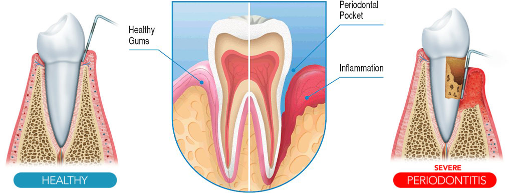 Diagram comparing healthy gums and periodontitis (gum disease). Illustrates tooth structure, inflammation, and bone loss.