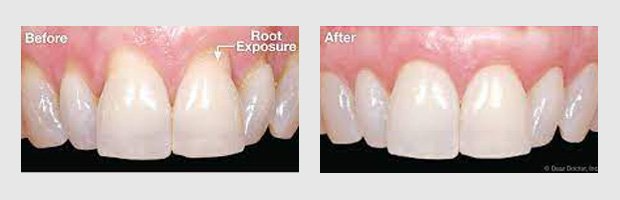 Before and after photos of a dental procedure to correct gum exposure, showing teeth with improved appearance.