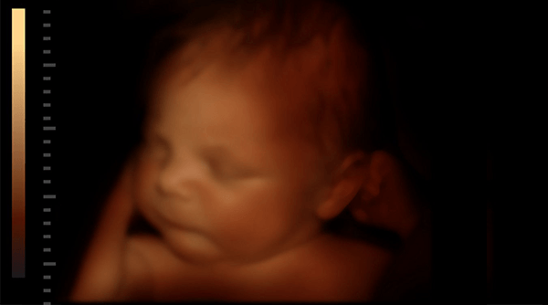 Ultrasound baby