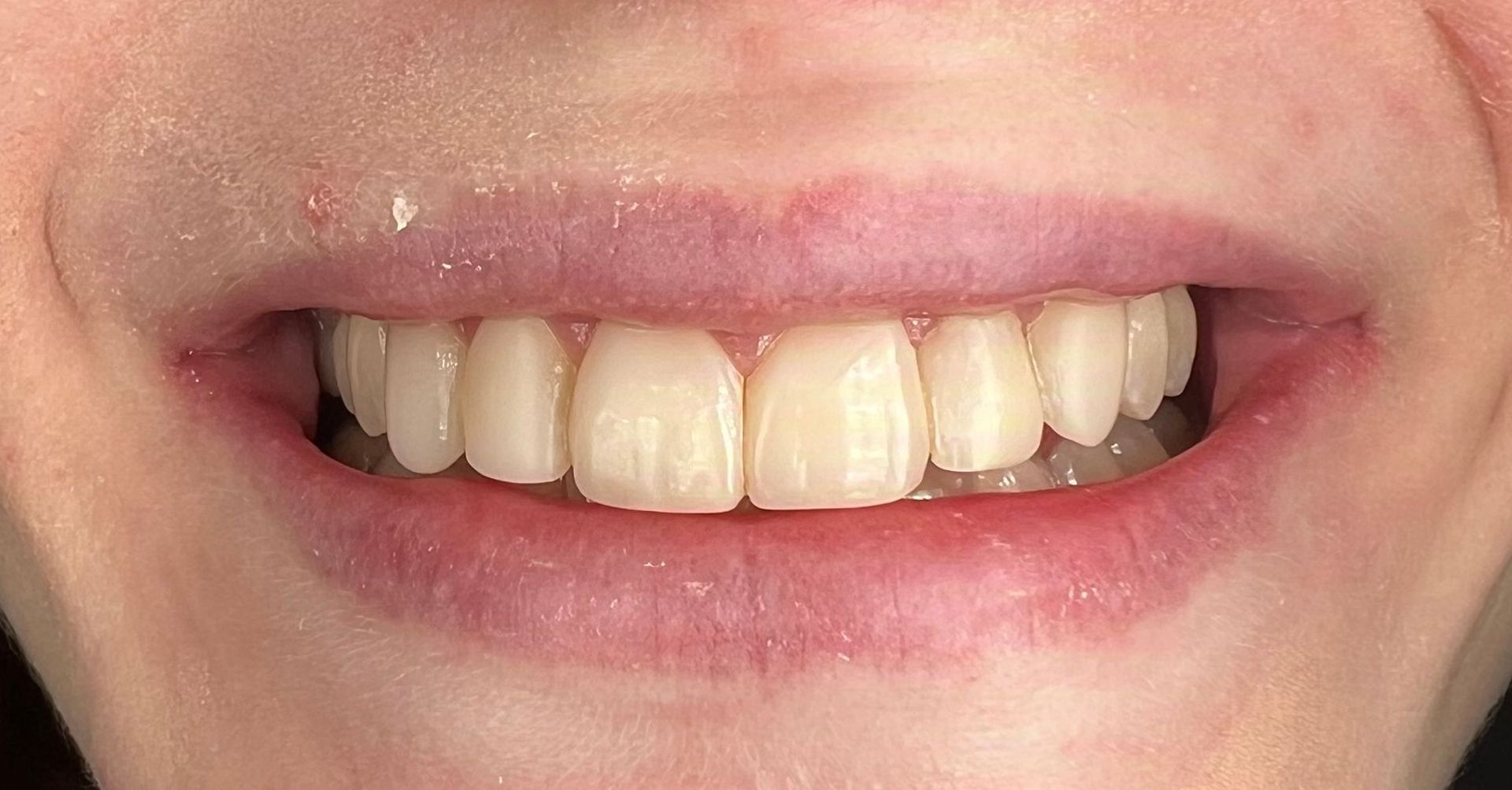 Close-up of a smiling person with straight, white teeth and pink lips.