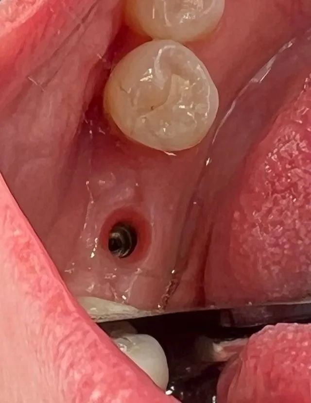 Dental implant in the upper gum with a molar and teeth visible.