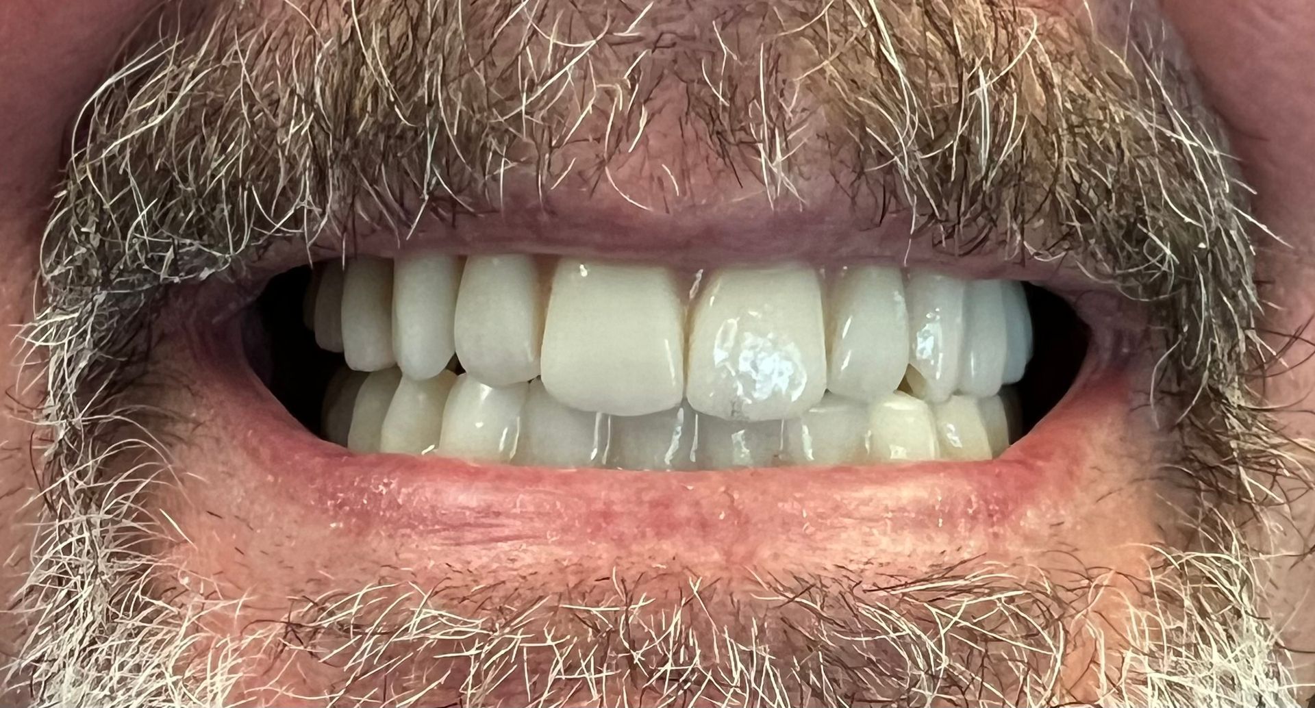 Close-up of a man's mouth smiling, revealing a full set of bright white teeth; he has a gray beard.