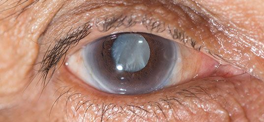 A close up of an eye with cataract