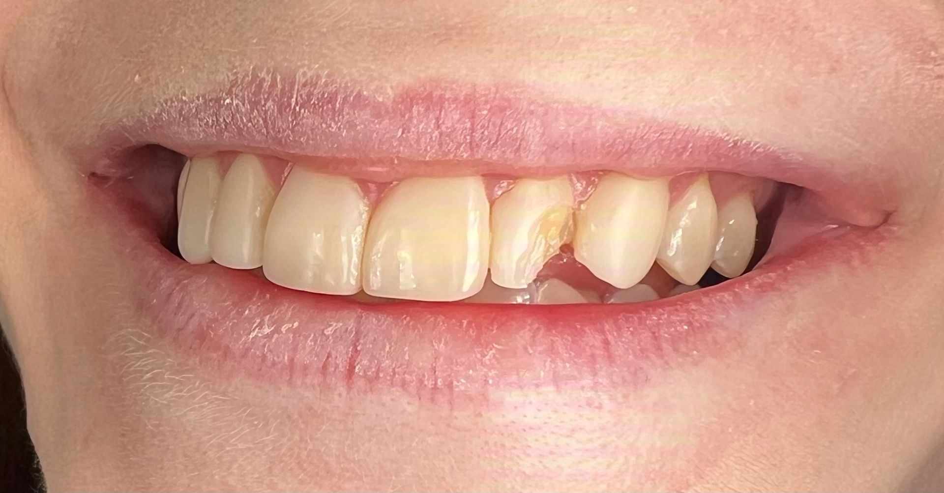 Close-up of person smiling, showing a chipped front tooth and slightly yellowed teeth.