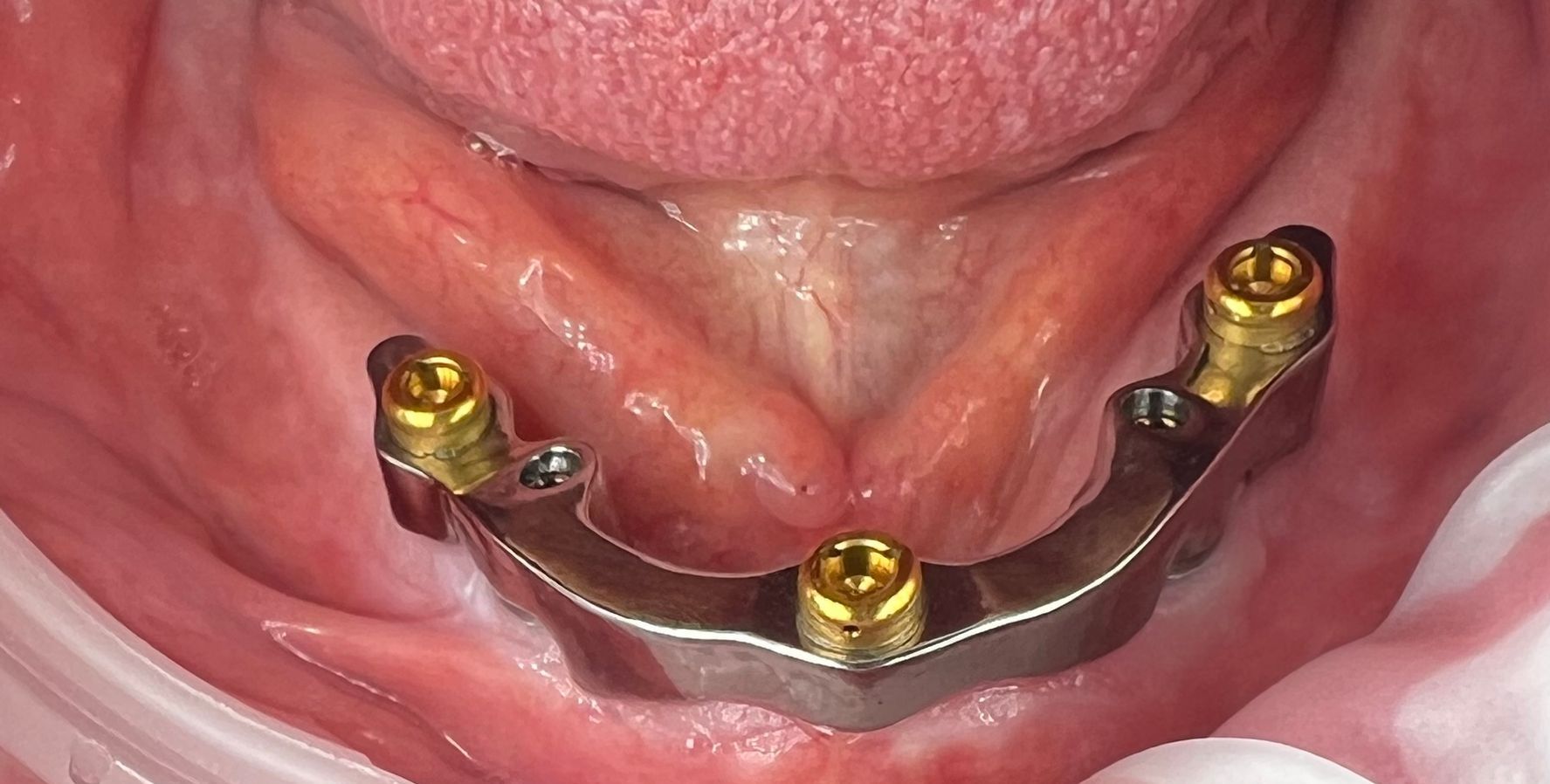 Dental implant bar with gold screws in a patient's mouth.