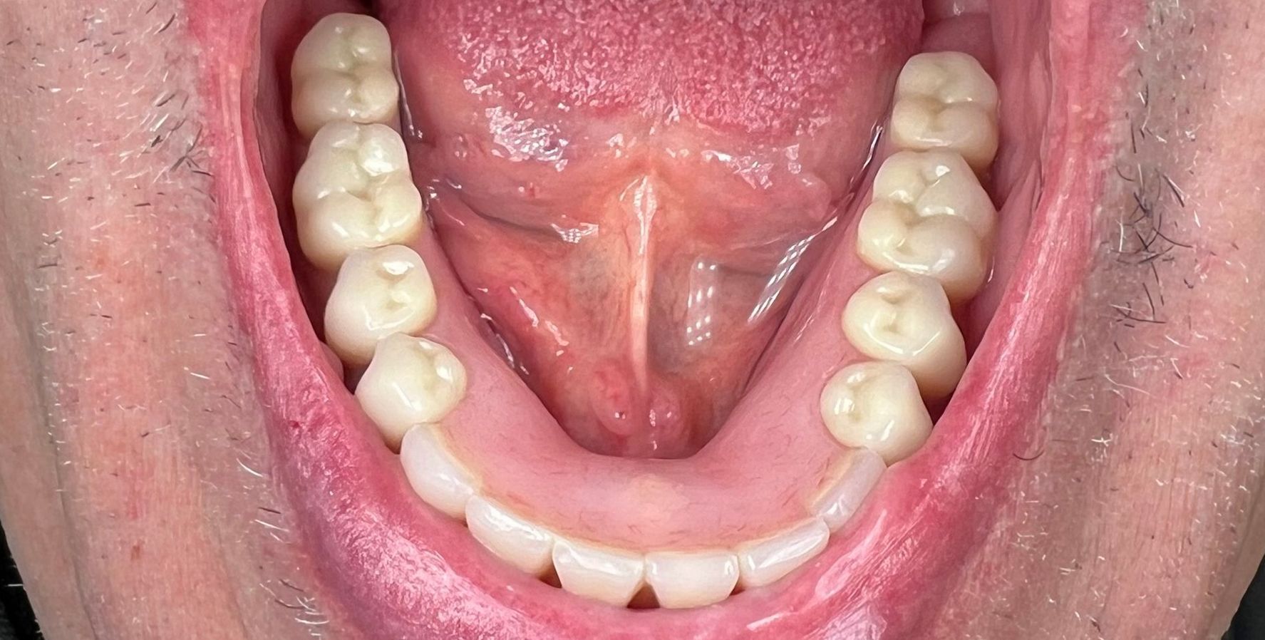 Inside view of mouth showing teeth and tongue.