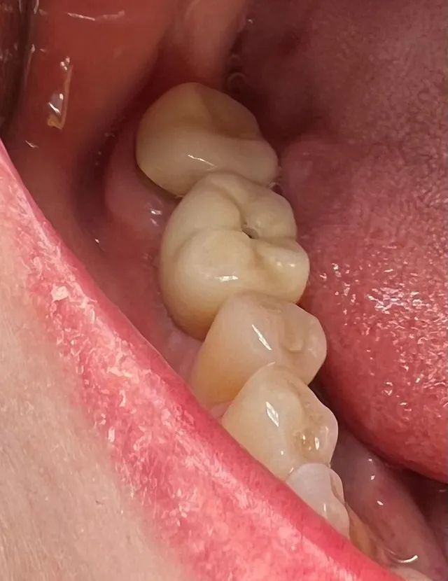 Close-up of a mouth showing three molars, with a light-colored dental crown on the top molar.