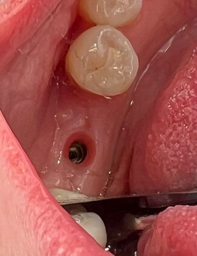 Close-up of a mouth showing a dental implant, with a back tooth in view.