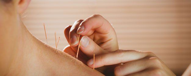Acupuncture