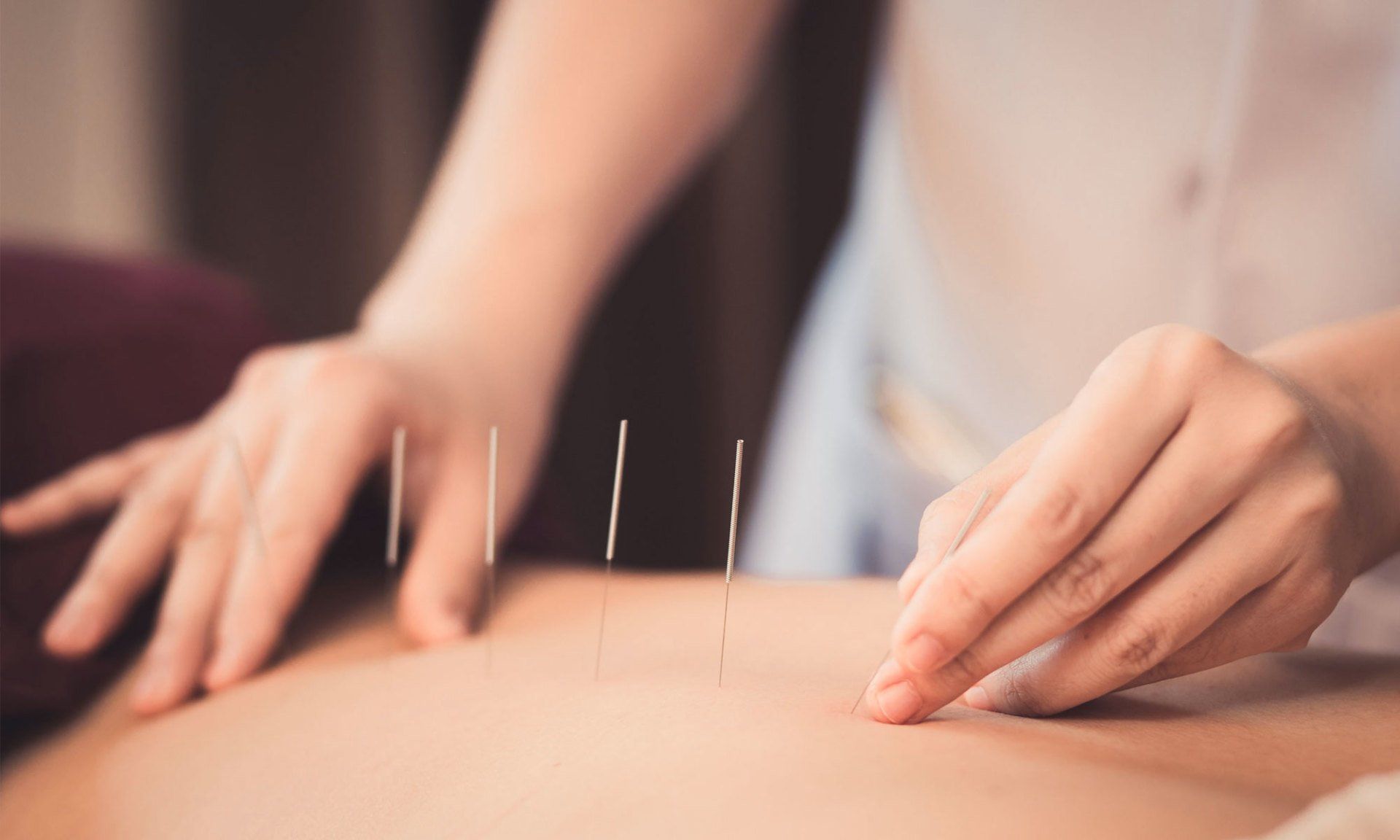 Acupuncture