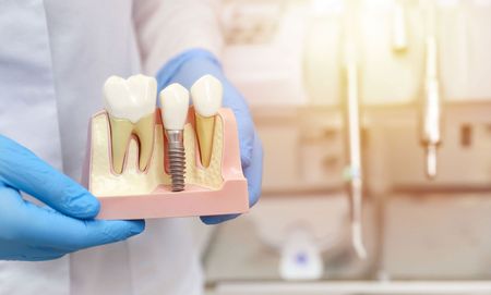 A dentist is holding a model of a dental implant.