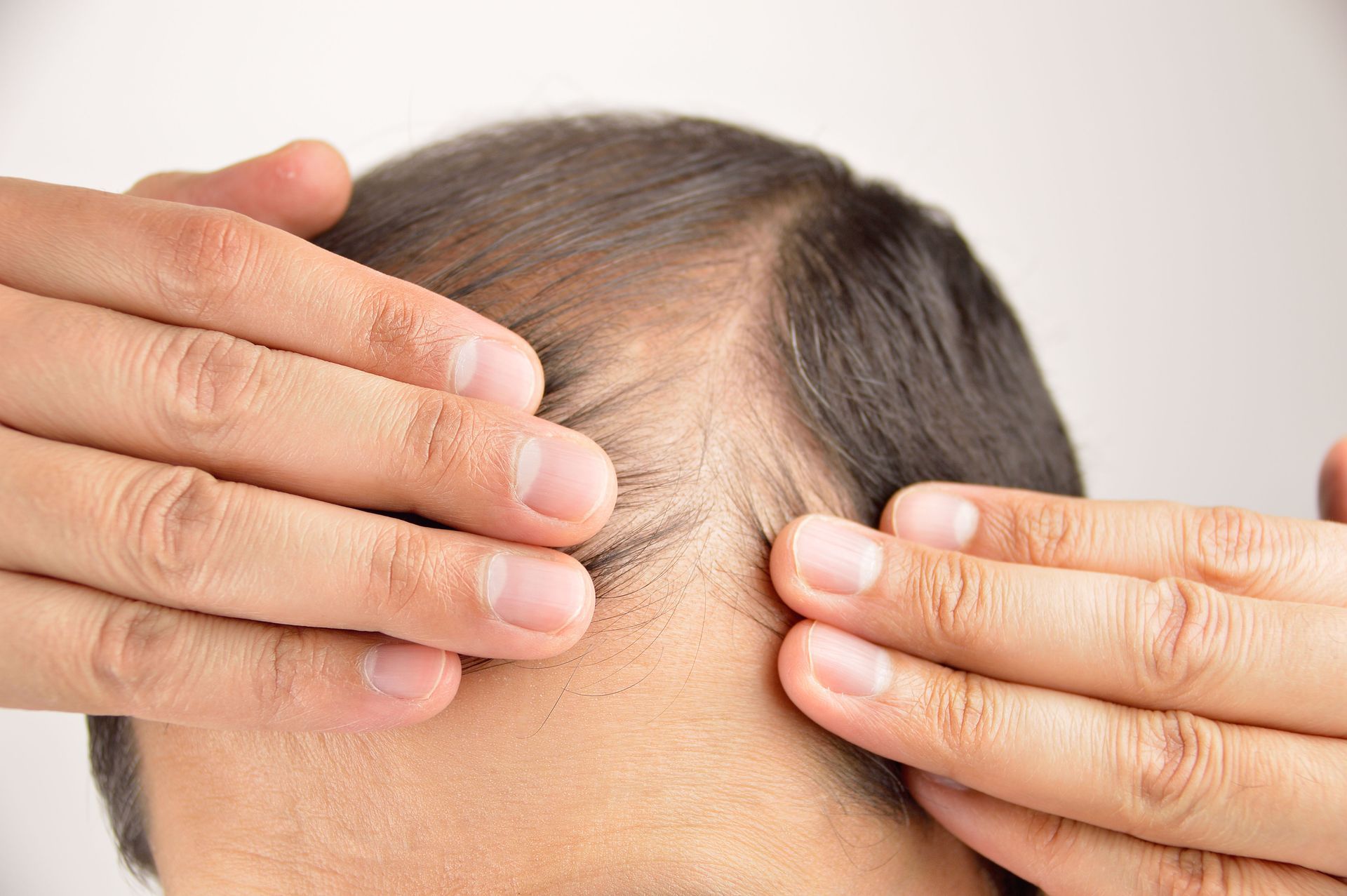 Hands examining a person's receding hairline. Gray hair, close up.