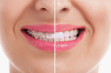 healthy woman teeth before and after