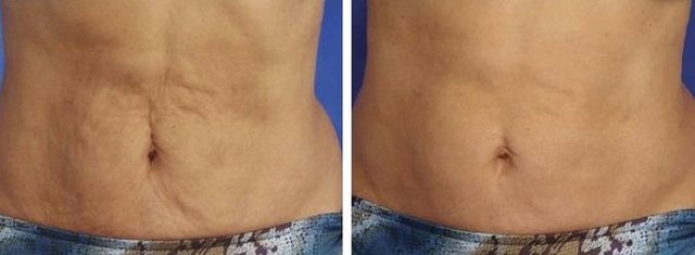 Laser Skin Tightening for Stomach Near Me