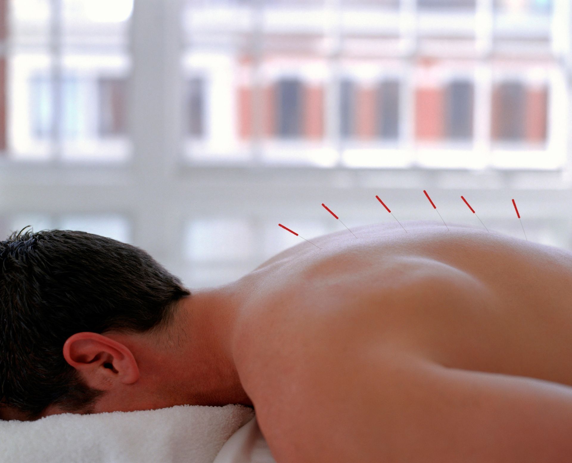 A man lying face down with six acupuncture needles in his back.